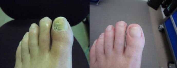 Foto's van voeten voor en na het gebruik van Zenidol-crème