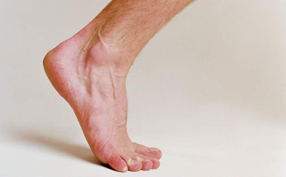voetschimmel symptomen