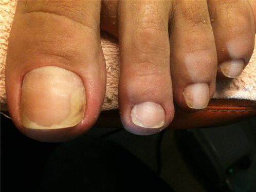 schimmelinfectie van de nagelplaat