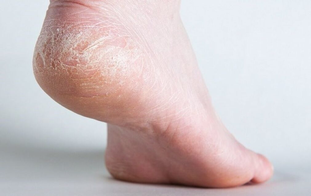 schimmel op de huid van de voeten