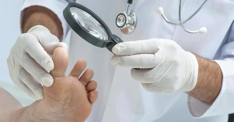 arts onderzoekt voeten met schimmel