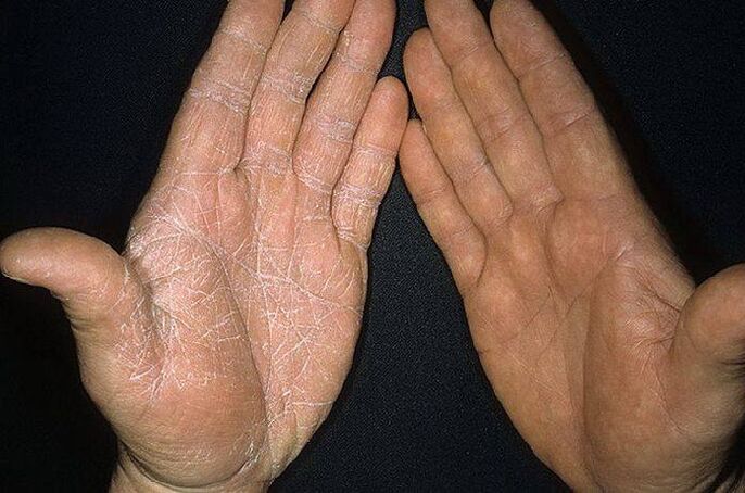 symptomen van een schimmel op de huid van de handen