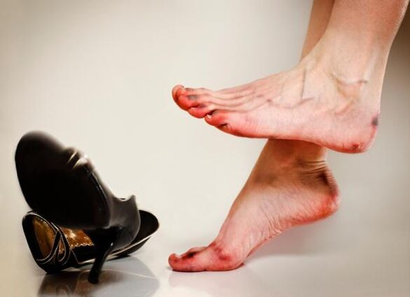 De ontwikkeling van teennagelschimmel kan worden veroorzaakt door strakke schoenen