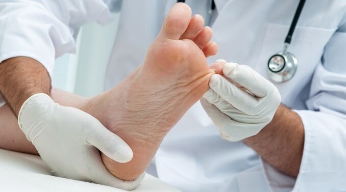 Onderzoek van de nagelplaat door een dermatoloog om onychomycose te diagnosticeren