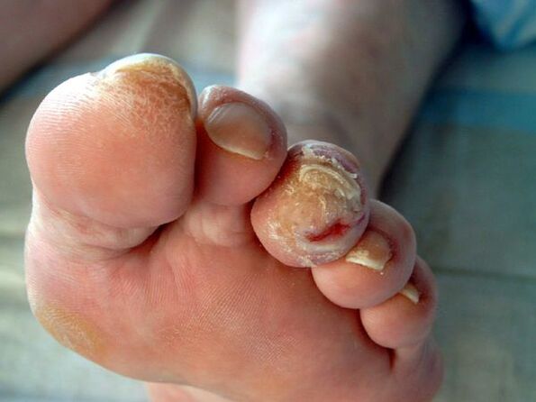 Diabetische voet en onychomycose