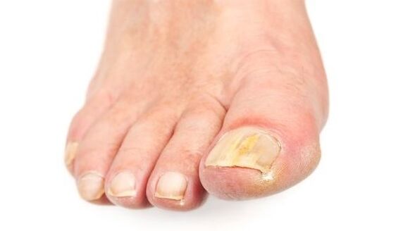 vergeling van de nagel met een schimmelinfectie